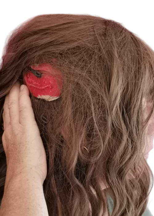Plaie cuir chevelu